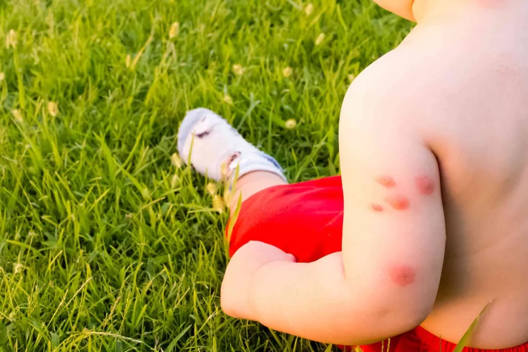 Children and Bee Stings
